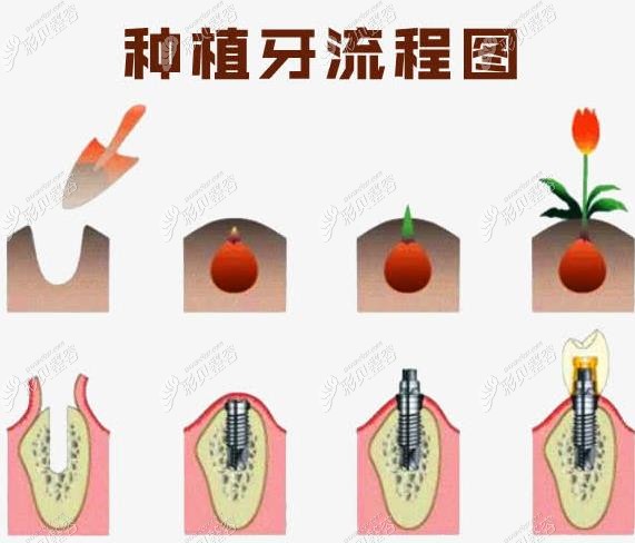 种植牙流程图