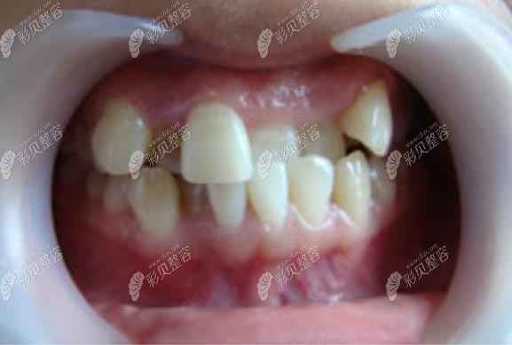 牙齿错位矫正术前照