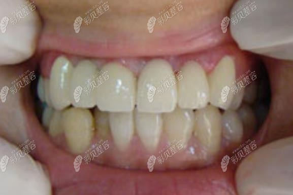 宜昌中汉口腔矫正牙齿术后照片