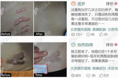 北京治疗疤痕好的医院排名榜，国丹、广济和南加3家上榜
