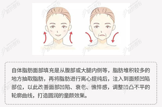 长春麦西美嘉自体脂肪填充面部原理和流程