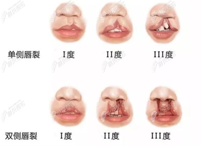 唇腭裂程度示意图