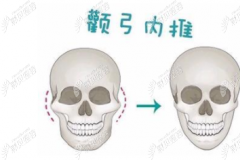 多图看懂颧弓内推和颧骨降低的区别,避免磨骨后脸还是很宽