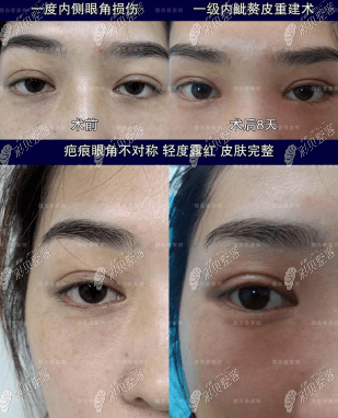 北京丽星翼美魏志香做眼角修复好不好？真人参考