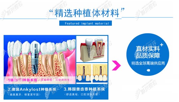 长沙牙大夫口腔常用的种植体品牌