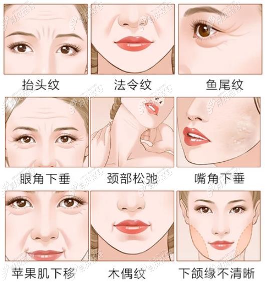 拉皮手术的适应症状表现