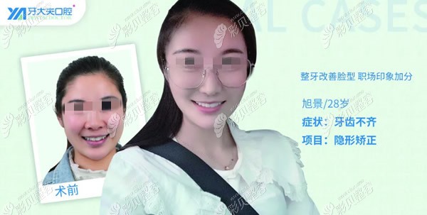 长沙牙大夫周权医生隐适美正畸图片