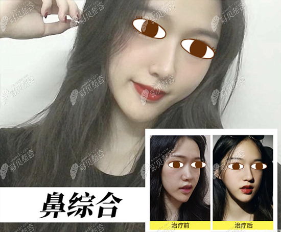 深圳阳光医疗美容医院鼻综合前后对比图