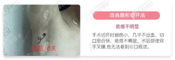 南京华美隆胸好不好？沈正宇假体隆胸切口隐蔽