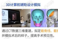 亲测:骨性凸嘴有必要做正颌手术,有正颌前后脸型改变图证实