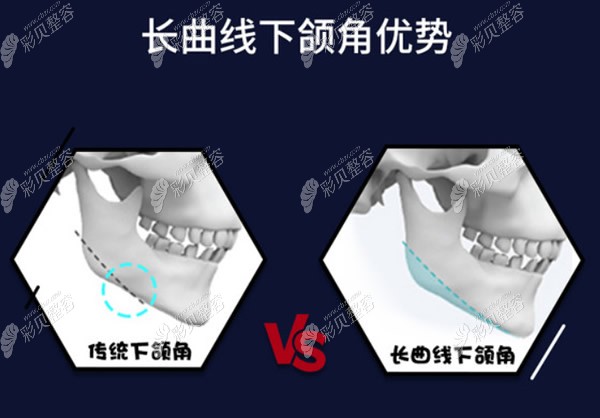 上海华美长曲线下颌角和传统下颌角手术区别