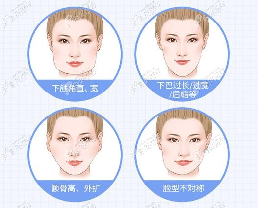 磨骨手术可以改善的脸型