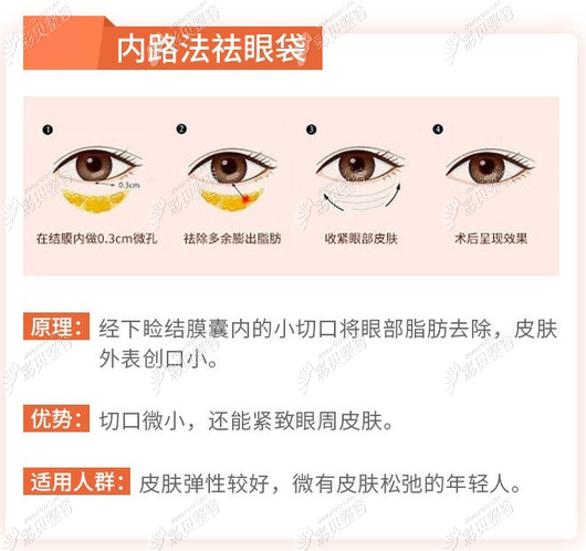 广州美莱内切祛眼袋方法