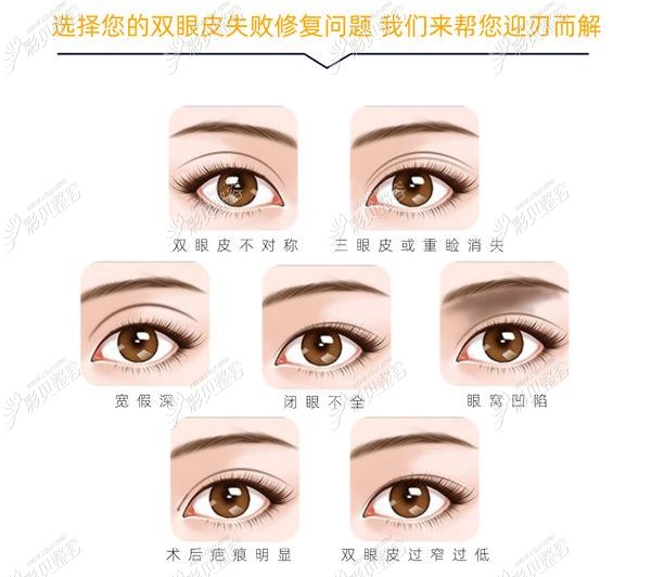 北京魏志香医生双眼皮修复技术蛮好的，还擅长双改单手术