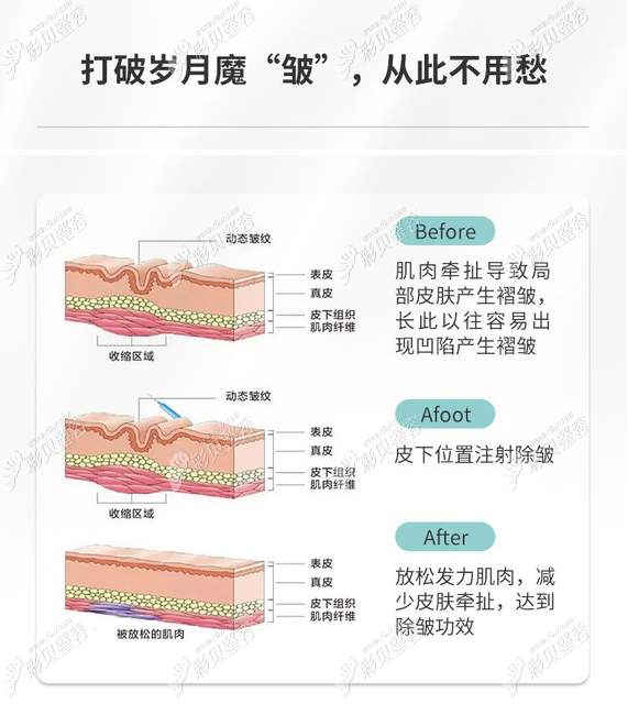 广州美莱除皱功效