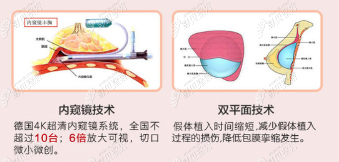 南京艺星隆胸怎么样 内窥镜+双平面植入假体的隆胸技术