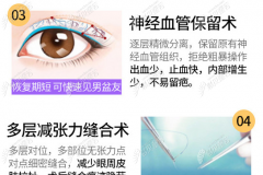 杭州做双眼皮技术好的医院，无论埋线还是切开恢复都挺快