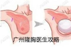 广州前十名隆胸医生已敲定,排名前三的医生做假体隆胸出名!