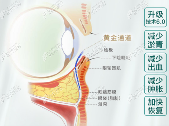 深圳健丽去眼袋的示意图