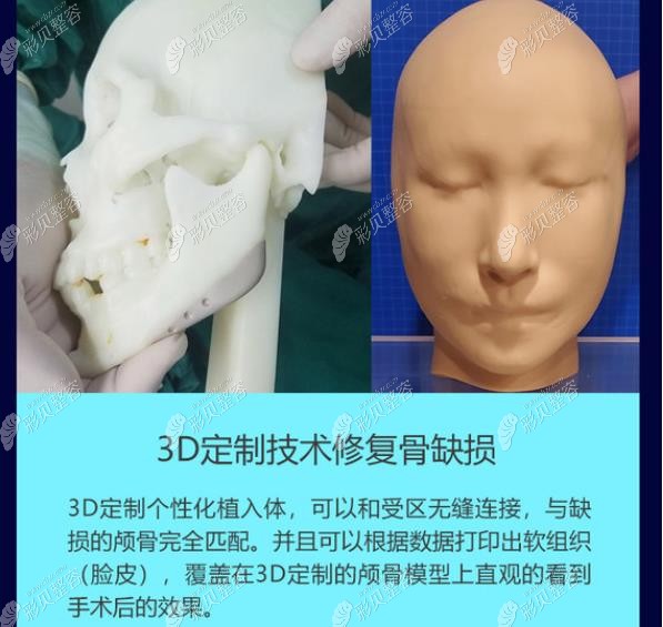 有磨骨资质的医院还可以提前模拟术后结果