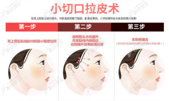 小切口拉皮手术的示意图