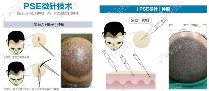 镊子植发技术和微针植发技术的区别