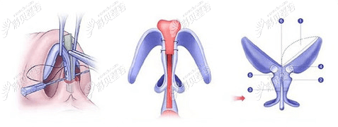 佛山曙光金子医学美容医院鼻修复过程图