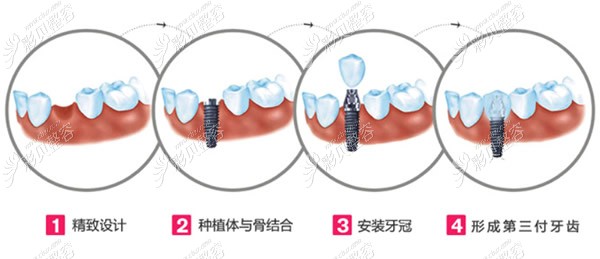种植牙过程和步骤