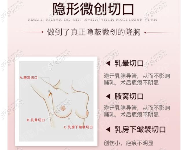 杭州艺星万连壮隆胸做得好吗，丰胸手术技术优势