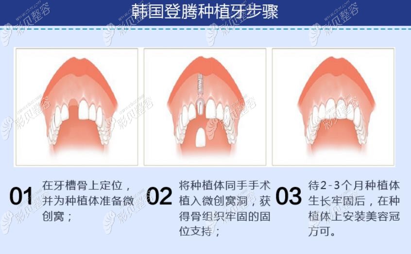 韩国登腾种植牙步骤