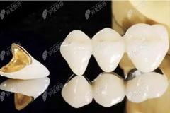 种植牙会影响核磁共振检查吗?纯钛的植体不会但金属牙冠会