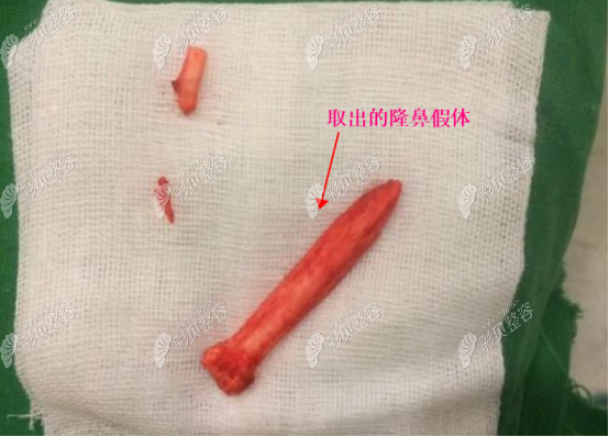 我一开始用的是韩士生科假体,也没发生假体破裂或者是包膜挛缩,也没有