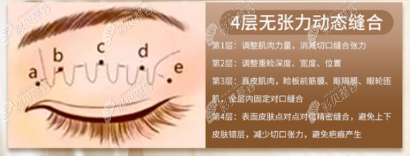 武汉艺星姜涛做眼睛怎么样，他和毕小丽医生做双眼皮谁好