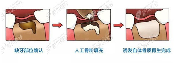 种植牙骨粉植入过程和步骤