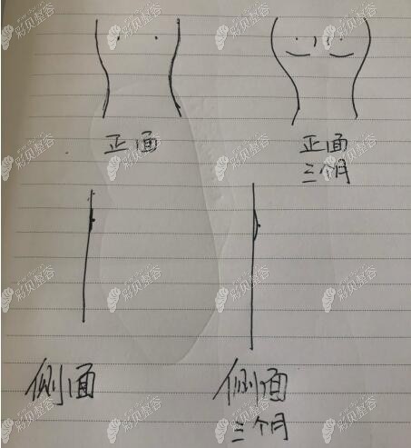 广州曙光刘杰伟医生做自体脂肪丰胸三个月前后对比