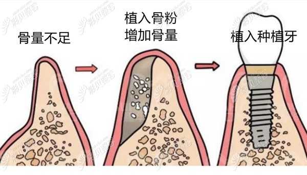 牙槽骨骨量不足 种植牙修复办法