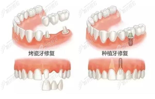单颗牙缺失烤瓷牙和种植牙修复的区别