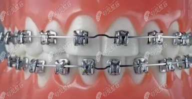 进口自锁托槽品牌3m怎么样