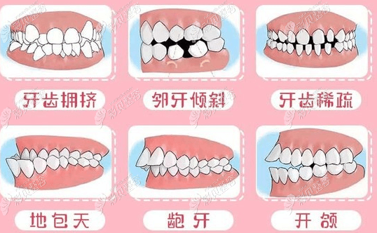 进口自锁托槽品牌3m和damon价格要结合牙齿情况定价