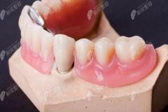 单颗缺失牙3种修复方式中：活动假牙/烤瓷牙/种植牙哪个好