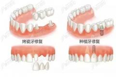 单颗缺失牙3种修复方式中：活动假牙/烤瓷牙/种植牙哪个好