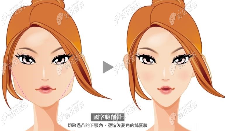 下颌角截骨手术能变小V脸