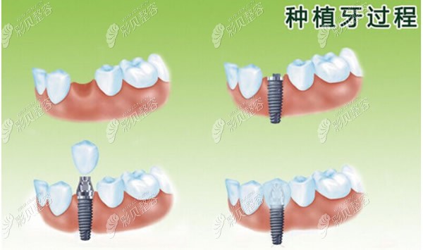 种植牙过程和步骤