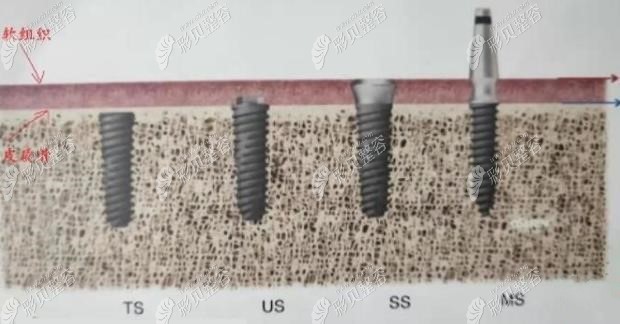 iti软组织水平和骨水平的区别 iti软组织水平和骨水平的区别
