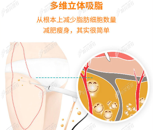 济南诺德整形吸脂技术