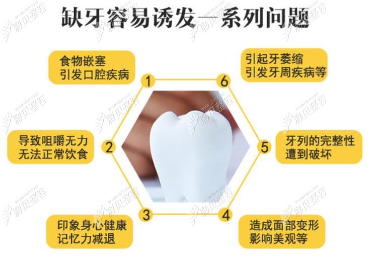 缺牙要尽早种植哦 缺牙要尽早种植哦