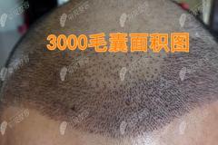 ​看深圳大麦微针植发多少钱一个单位+植发2000个毛囊面积图