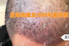 ​看深圳大麦微针植发多少钱一个单位+植发2000个毛囊面积图