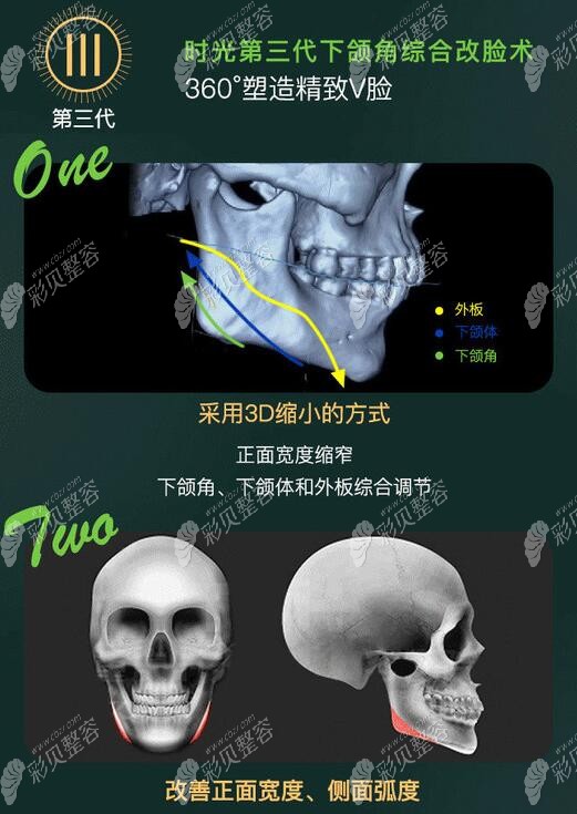 陈小平医生做的第三代下颌角综合改脸型技术