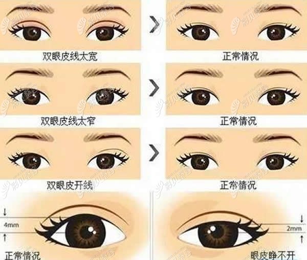 上海陈红梅医生做眼修复怎么样?用顾客割双眼皮口碑来解答
